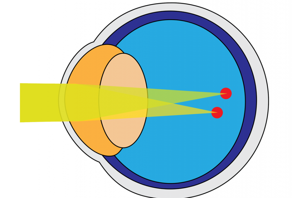 Refractive Error Astigmatism