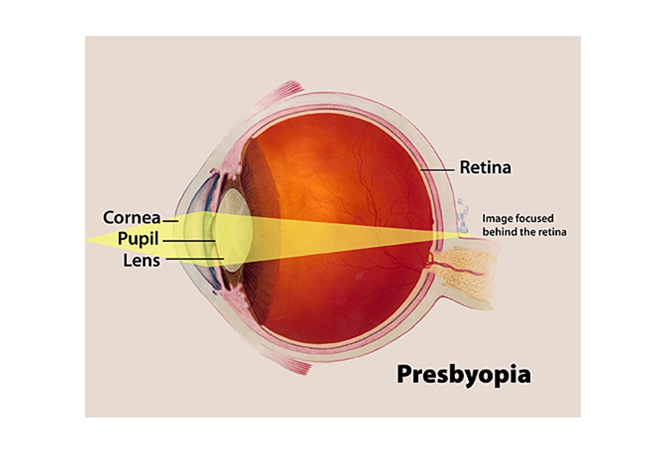 Refractive Error - Presbyopia