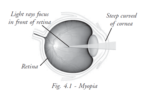  Myopia 