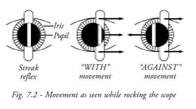  Movement on the retinoscope 
