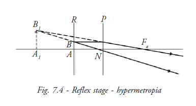  Reflex Stage Hypermetropia 