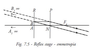 Reflex Stage Emmetropia 