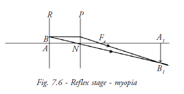  Reflex Stage Myopia 