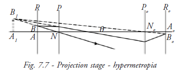 Projection Stage Hypermetropia 