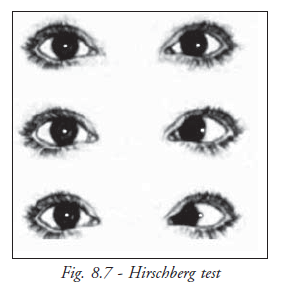  Hirschberg Test